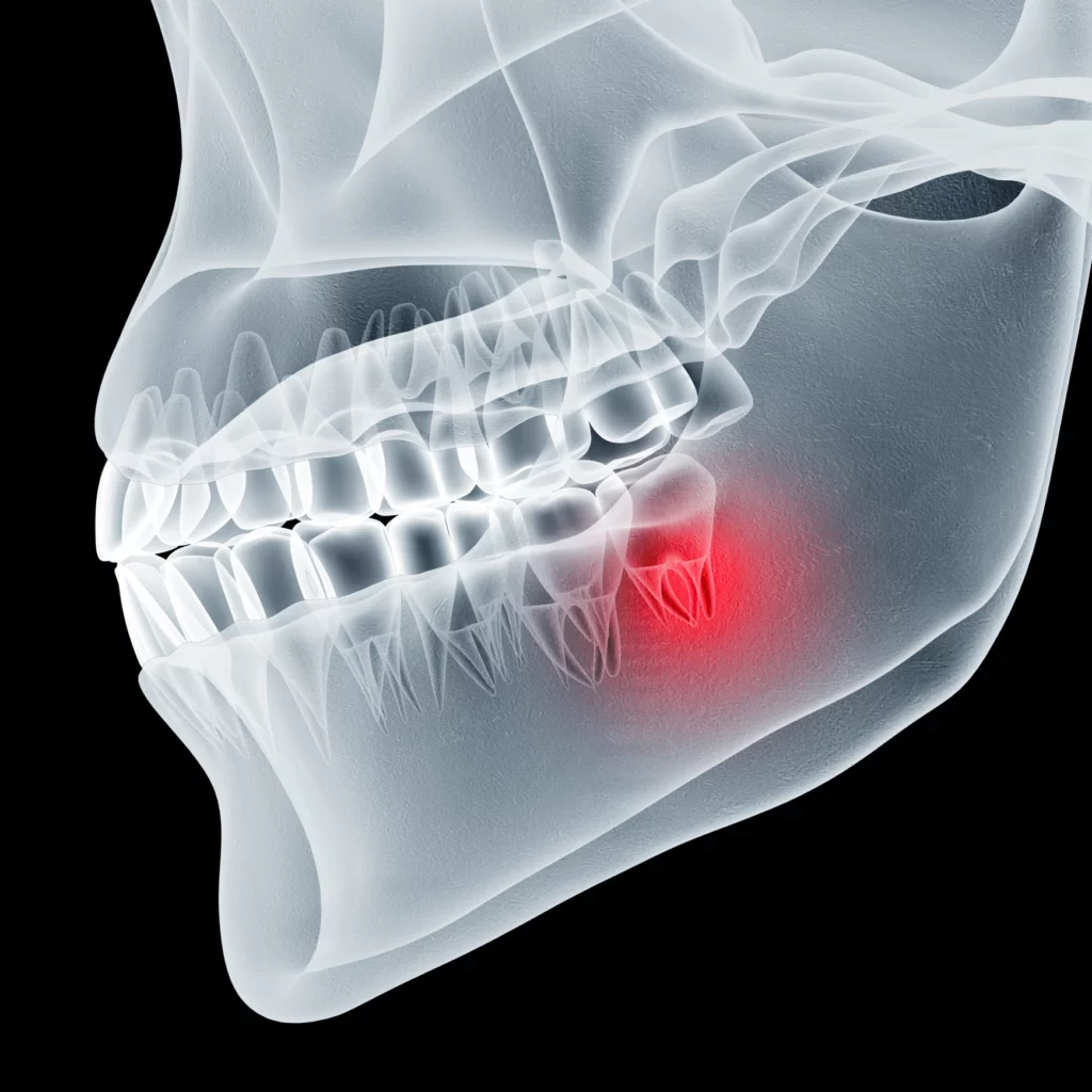wisdom teeth removal in Nashville, TN